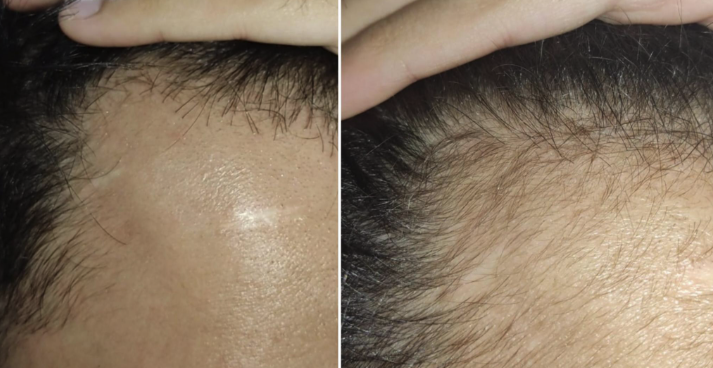 Transformation 4 - 2 Months