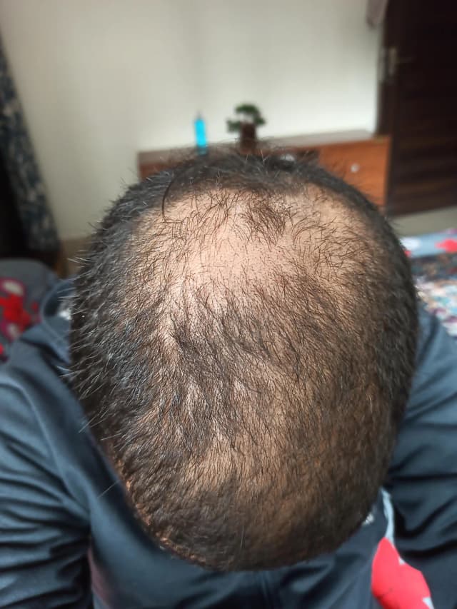 Hair loss stress impact
